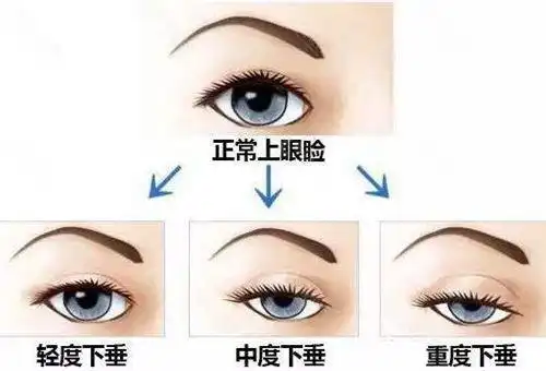 主要就是因为上睑提肌无力导致的上眼皮下垂,遮挡了一部分瞳孔,眼睛看