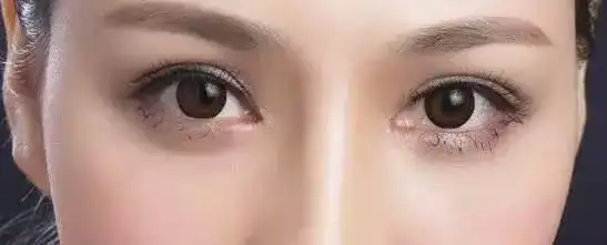 南京艺星整形医院美杜莎美眼术让你get属于自己的双眼皮风格