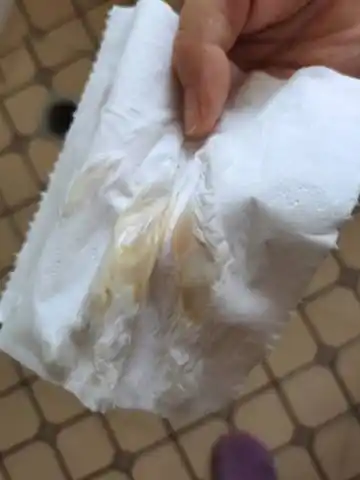 育儿问答 怀孕期 有没有宝妈孕早期出褐色分泌物的,今天孕7周5天了