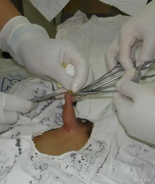 【原创】包皮环切术 (手术过程图片)