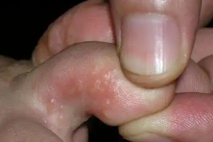 脚上起小水泡很痒是怎么回事