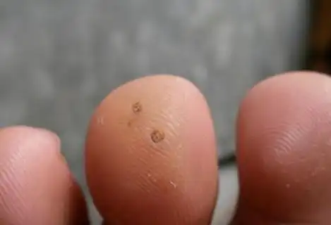 肉刺如何去除好?小肉刺竟藏大危害,希望你注意