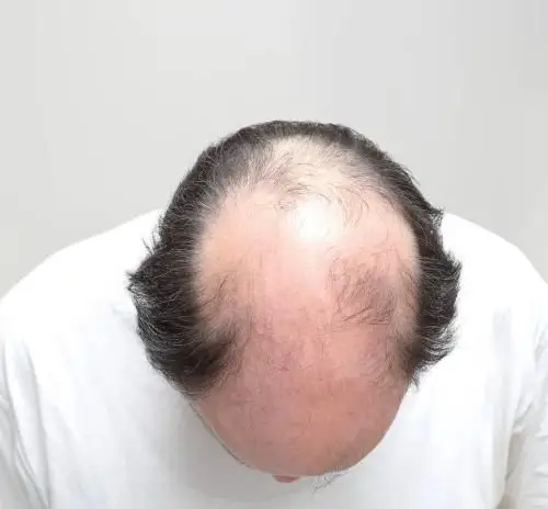 健康90后脱发大军你的没毛病可能是吃错了