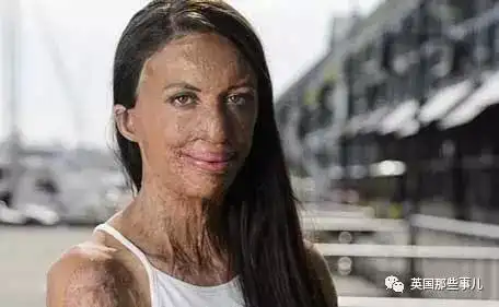 又相信爱情了美女模特被大火毁容男友视颜值如粪土不离不弃