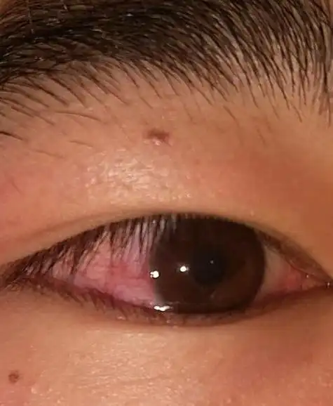 眼睛里有红血丝怎么消除(眼睛里有很多红血丝是什么原因)