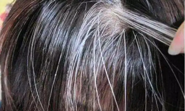 "明明家里也没有什么遗传性白发病之类,怎么会长白头发呢?