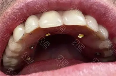种植牙全口牙需最少种多少颗植体听说上下6颗植体就能搞定