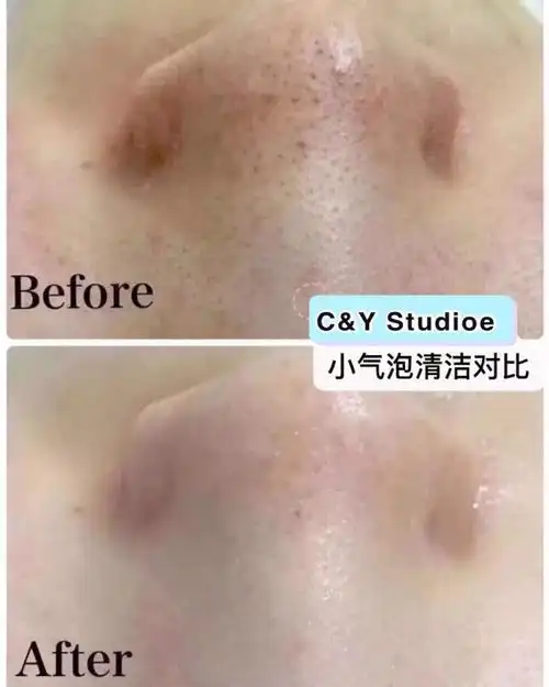 利用强效负压及独特的涡流探头,融合纳米级气泡水,清洁毛孔毛囊中的