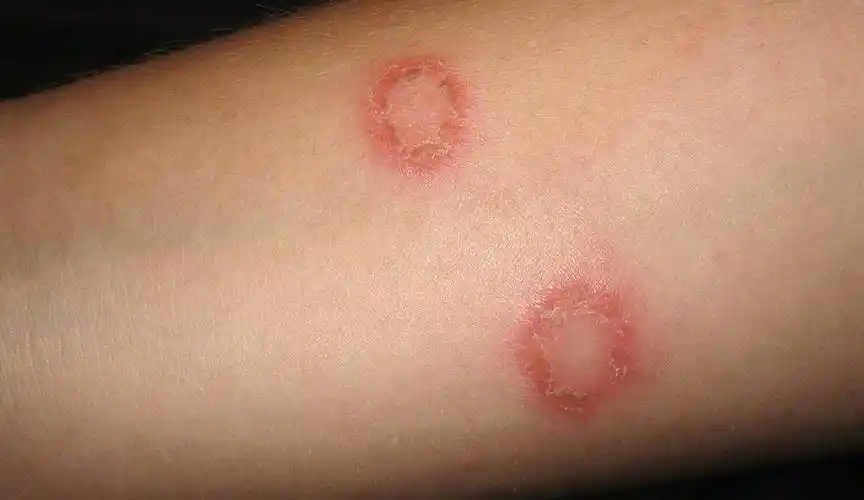 14种湿疹和皮炎类的儿童皮肤病图片及临床特征和鉴别诊断 [病例帖]