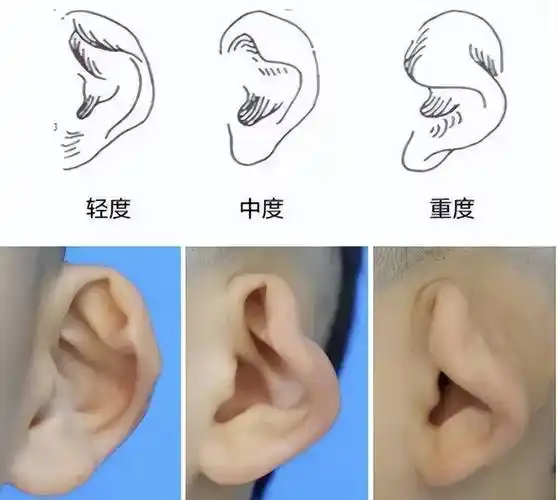 图片来源于网络杯状耳是一种先天性耳廓畸形,形状介于招风耳与小耳