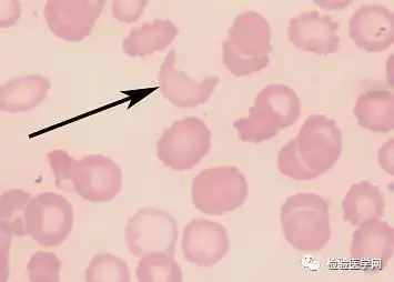外周血细胞形态学室间质评合辑红细胞