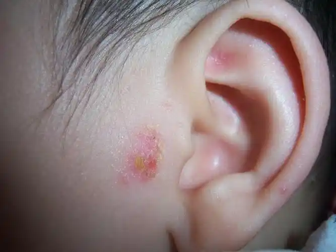 外耳道湿疹图片