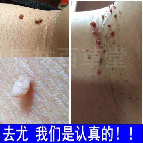丝状疣脖子颈部腋下肉粒去除扁平疣药膏祛尤灵点疙瘩瘊子皮赘神器