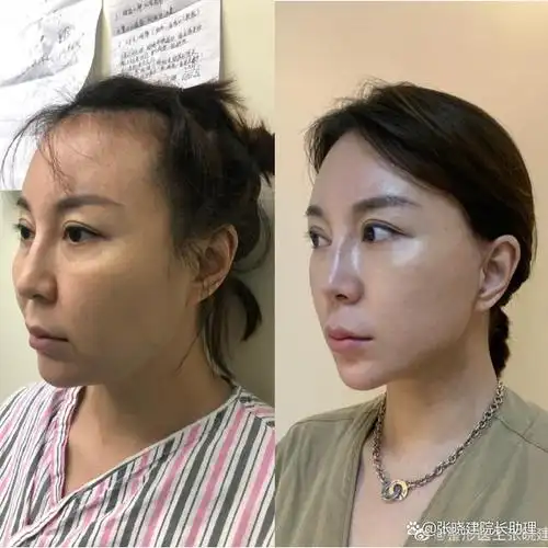 张晓建医生面部抗衰案例脂肪填充过度