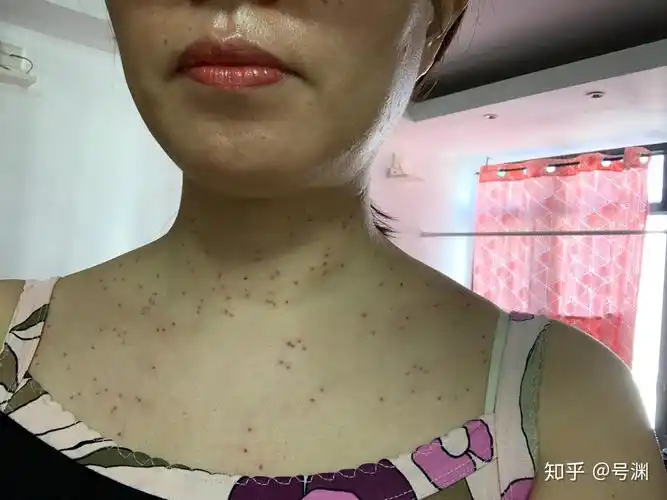 丝状疣脖子上女性医生说要激光扫有别的办法吗