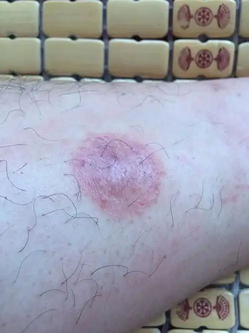 这是什么癣,怎么治,很痒的.