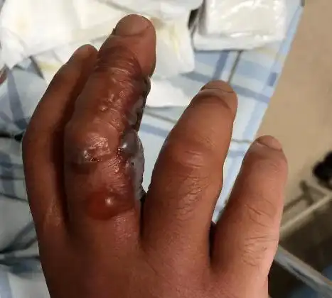 可怕温州男子感染吃人肉细菌严重可致命