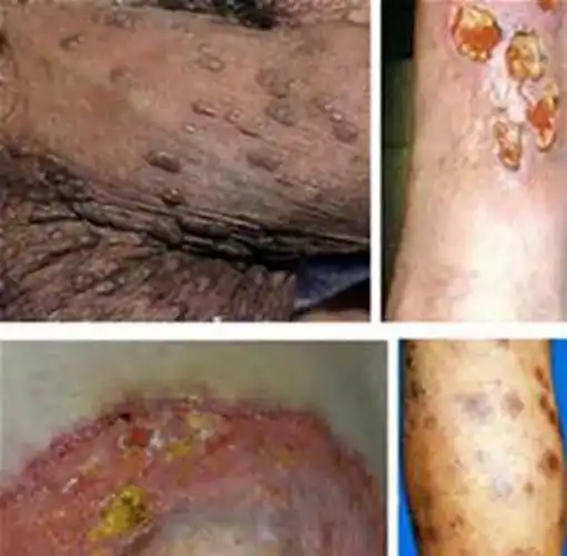 一期梅毒图片——肛门部硬下疳图片_有来医生