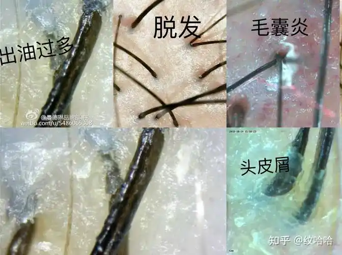 带你了解你的头皮健康