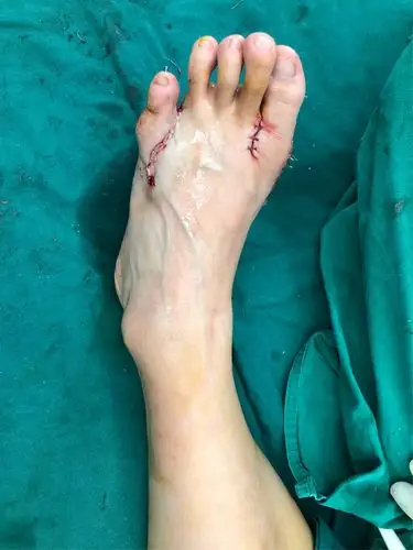 chevron截骨 多趾切除矫正治疗先天性双足多趾畸形合并双足外翻