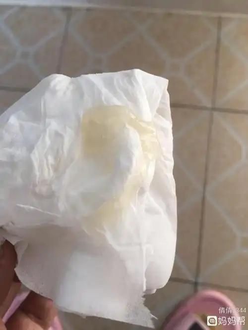 一般来说,女性在排卵期分泌物会增多,出现透明拉丝白带,白带可以拉得