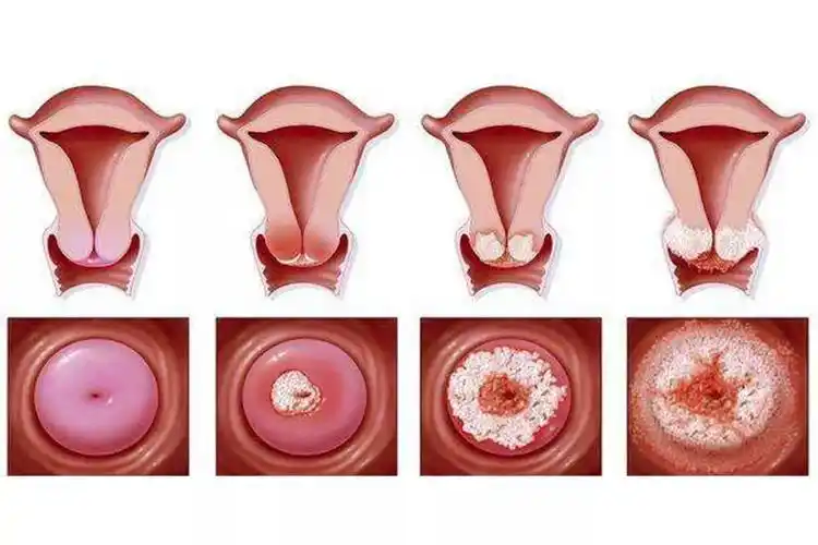 妇科炎症也有不同:4种常见妇科病,女性请心中有数