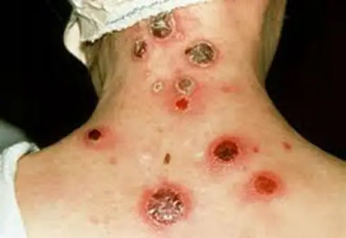 女性梅毒三期图片_有来医生