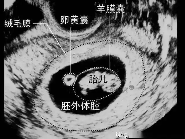 周增大,包蜕膜与真蜕膜逐渐融合;①底蜕膜:以后发育成胎盘的母体部分