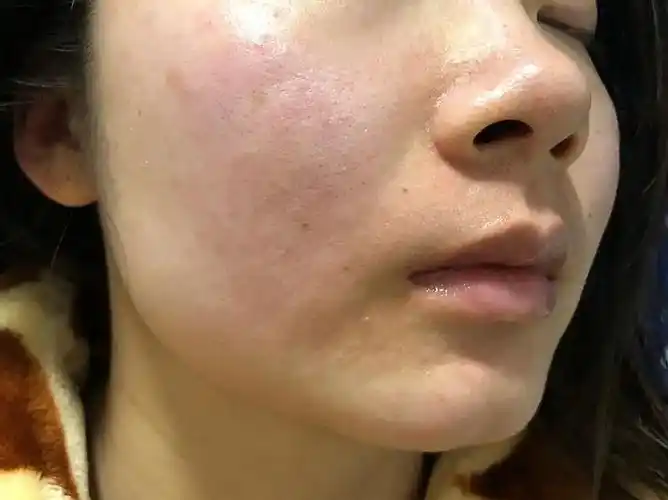 皮肤屏障受损=敏感肌?你也这样认为吗? - 知乎