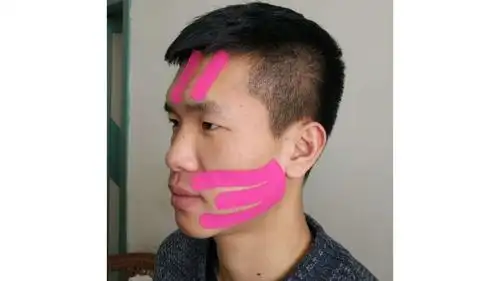 面神经炎老百姓俗称面瘫,多为单侧发病,常与病毒感染,面部受凉有关