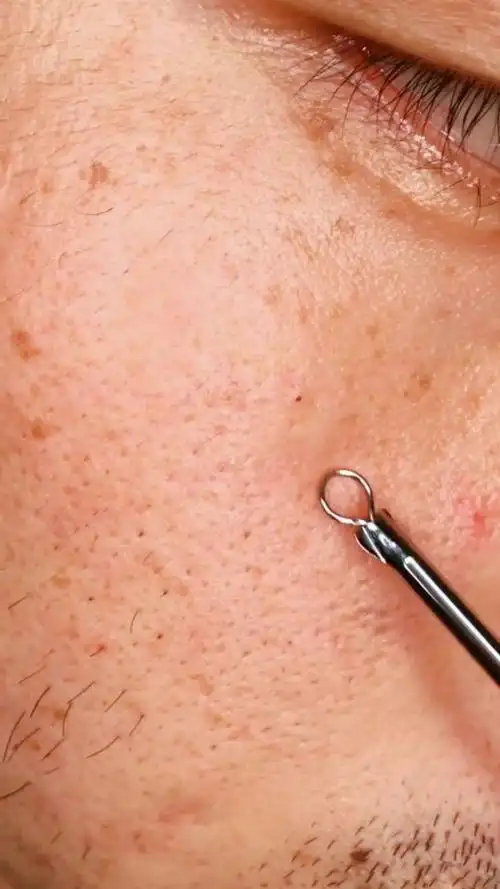 毛孔 粗大 堵塞 你有吗