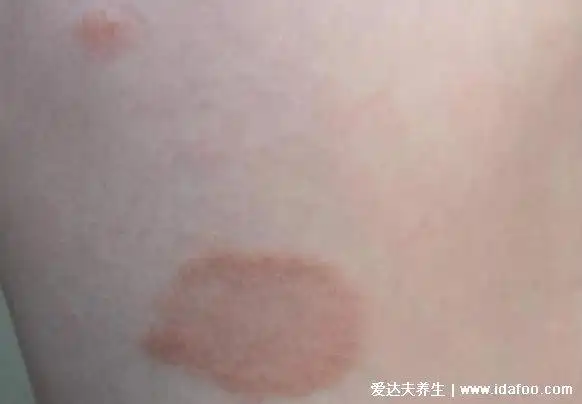 18种常见的皮肤病图片分享皮肤病对照图症状及名称