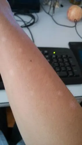 看下图,我胳膊出现了这种白斑,是什么病啊