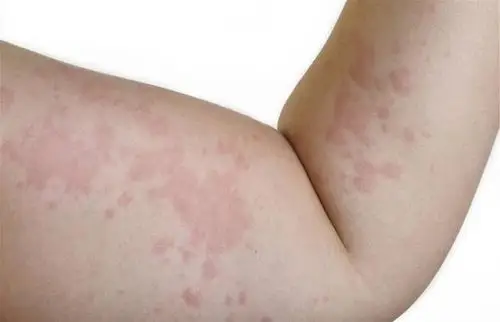 围麻醉期全身麻醉突发过敏性休克典型案例分享一