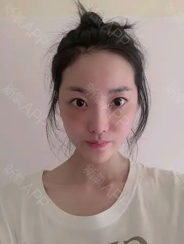 自体脂肪填充全脸