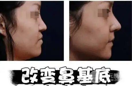 垫鼻基底效果对比
