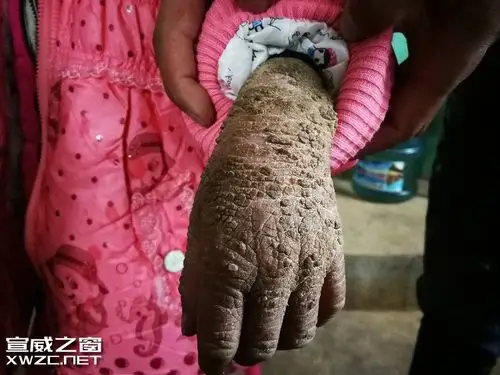 宣威一小女孩得了皮肤怪病像树皮