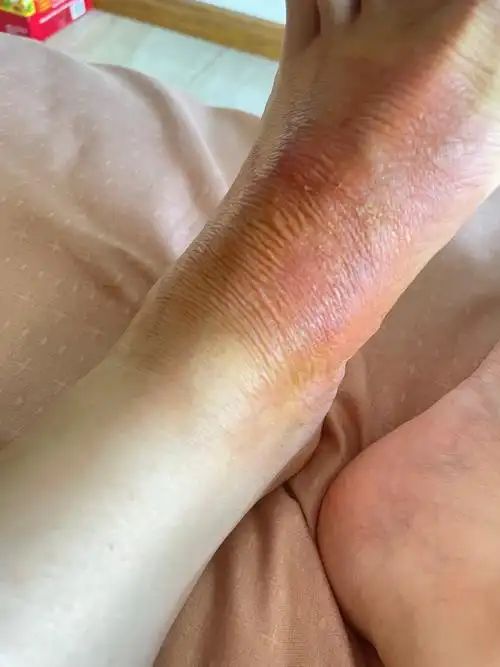 记录孕妇脚面开水烫伤恢复过程