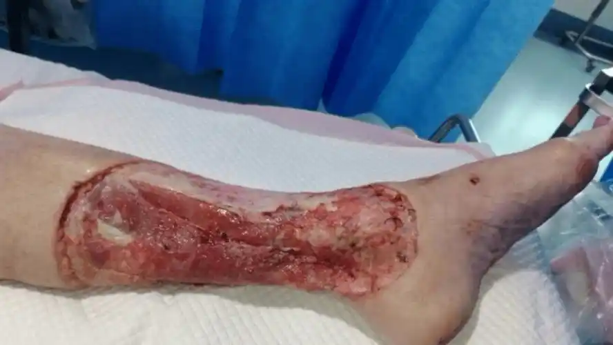 被它咬了一口布村大叔4周9次手术小腿仍惨遭截肢华人注意这种生物在