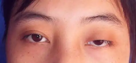 上海上睑下垂矫正术怎么样