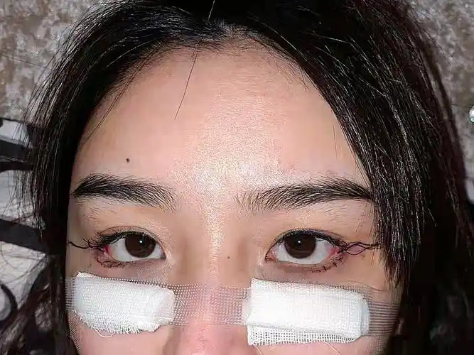 眼睑下至外眼角第一天