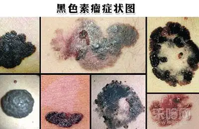 请放宽心,这才是恶性黑色素瘤的真面目