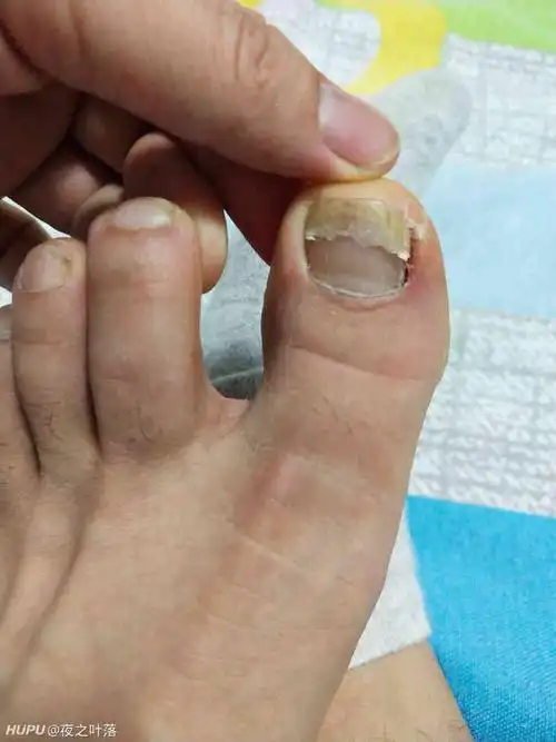 踢球大母脚指甲从中间断了 怎么处理?