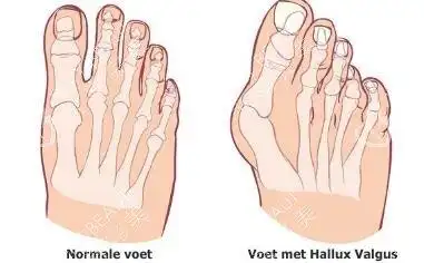 大脚骨手术是切除骨头吗分情况拇外翻手术过程图解给公布