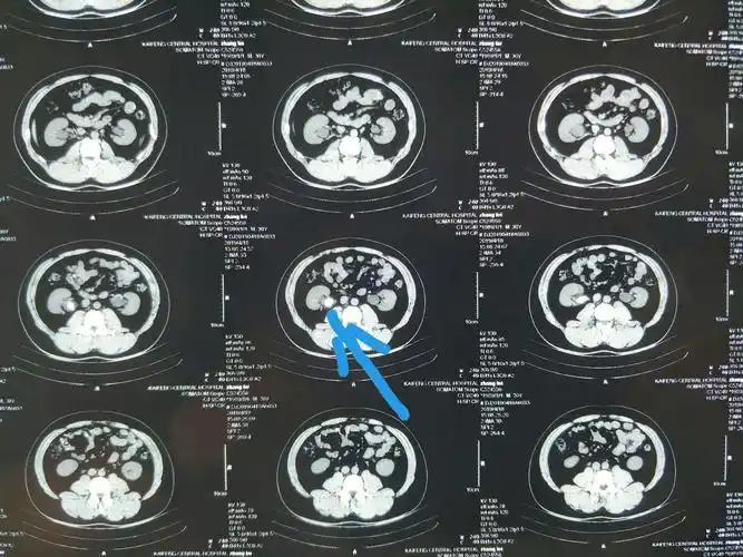 肾轻度积水,肾盏扩张轻微.
