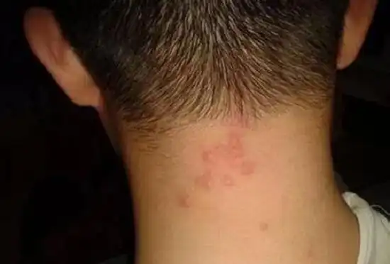 头皮毛囊炎的症状是什么?