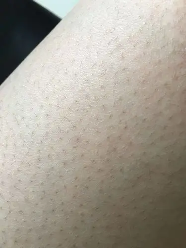 请问 有哪位高人知道 腿上毛孔这样是什么原因 怎么治?