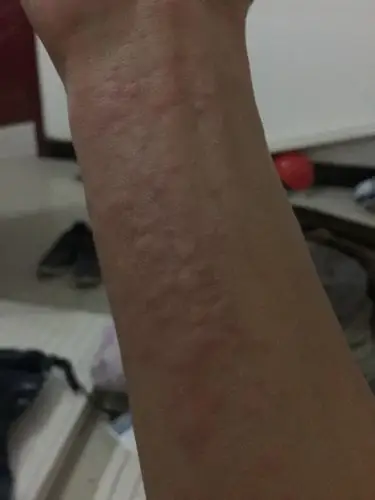 荨麻疹! 每天下午先从胳膊或者腿部股部臀部开始长,不能抓,越抓