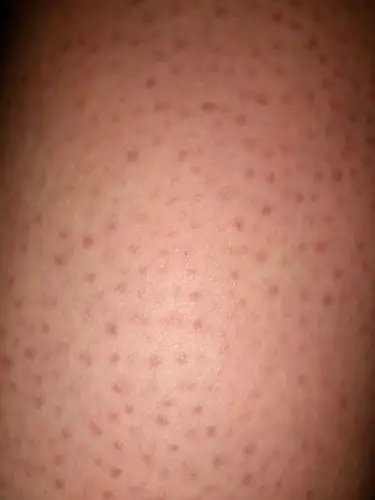 大腿上的皮肤怎么这样是什么皮肤病啊一直都这样的