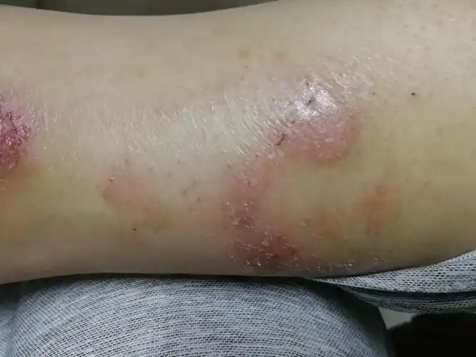 近两年左侧内踝下部皮肤反复溃烂,这是什么皮肤病